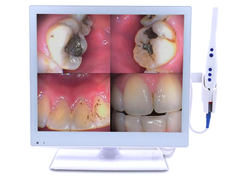 17inch Wired Intraoral Cameras Wireless Dental Camera Monitor